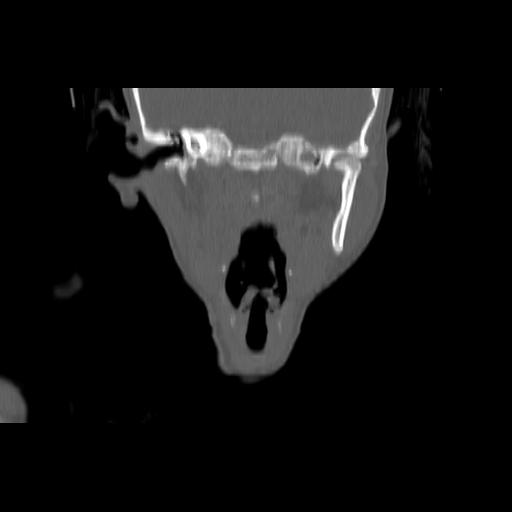 Carcinoma of the maxillary antrum (Radiopaedia 53805-59888 Coronal bone window 84).jpg