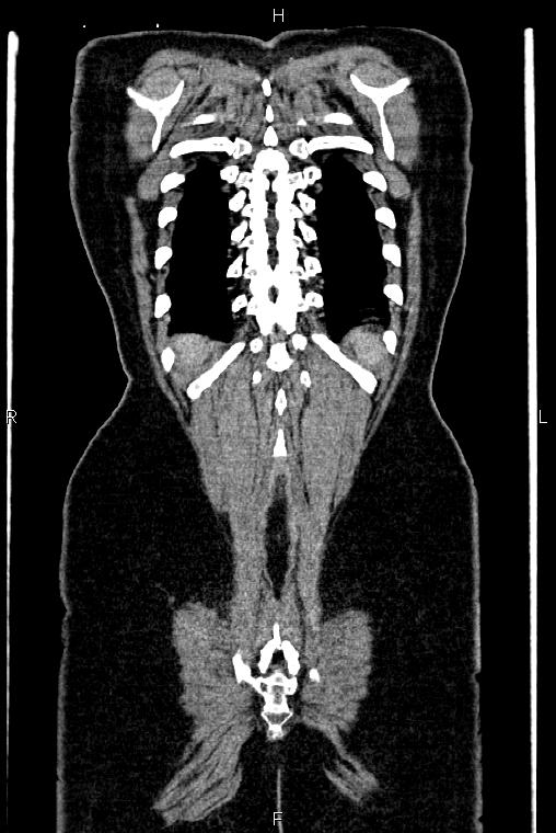 Carcinoma of uterine cervix (Radiopaedia 85861-101700 C 54).jpg