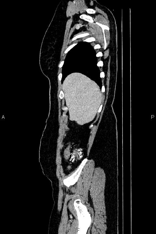 Carcinoma of uterine cervix (Radiopaedia 85861-101700 D 6).jpg