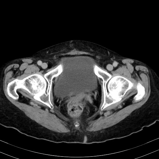 Carcinosarcoma (Radiopaedia 70401-80503 A 65).jpg