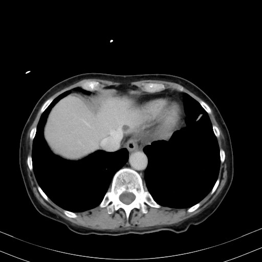 Carcinosarcoma (Radiopaedia 70401-80503 A 7).jpg