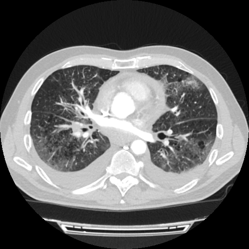 Cardiac tamponade (Radiopaedia 78607-91368 Axial lung window 47).jpg