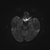 Cardioembolic stroke- ACA and MCA territories (Radiopaedia 58904-66136 Axial DWI 36).jpg
