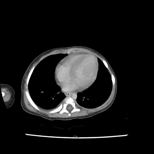 Caroli disease with autosomal recessive polycystic kidney disease (ARPKD) (Radiopaedia 89651-106703 B 1).jpg