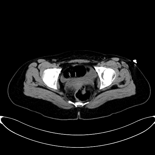 Caroli disease with medullary sponge kidney (Radiopaedia 82622-96804 Axial non-contrast 71).jpg