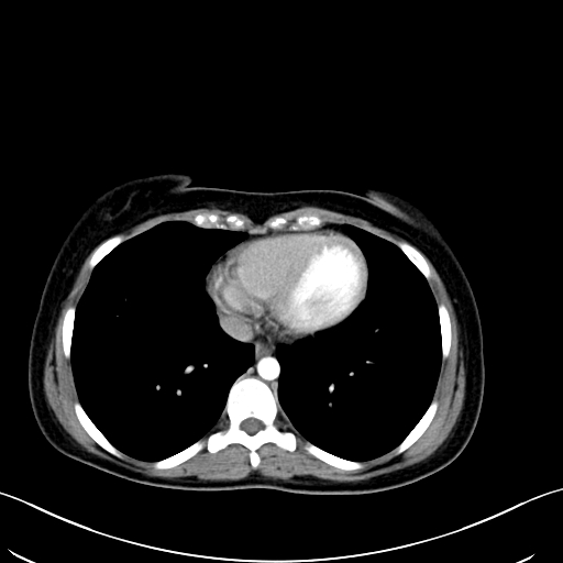 Caroli disease with medullary sponge kidney (Radiopaedia 82622-96804 C 7).jpg