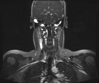 Carotid body tumor (Radiopaedia 12777-12912 MRA 44).jpg