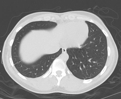 File:Catamenial pneumothorax (Radiopaedia 54382-60600 Axial 60).png