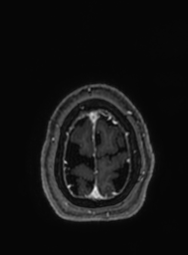 Cavernous hemangioma of the cerebellar falx (Radiopaedia 73025-83724 Axial T1 C+ 35).jpg