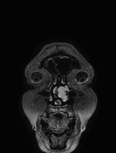 Cavernous hemangioma of the cerebellar falx (Radiopaedia 73025-83724 Coronal FLAIR 1).jpg