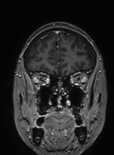 Cavernous hemangioma of the cerebellar falx (Radiopaedia 73025-83724 Coronal T1 C+ 84).jpg