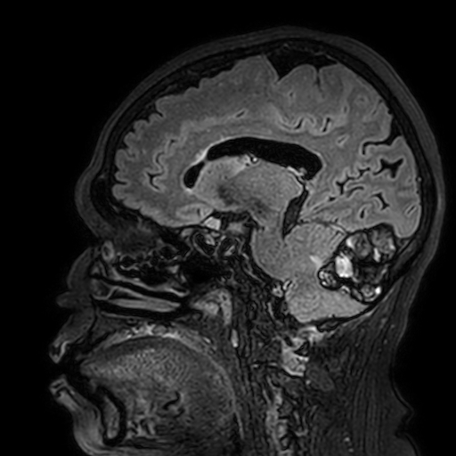 File:Cavernous hemangioma of the cerebellar falx (Radiopaedia 73025-83724 Sagittal FLAIR 129).jpg