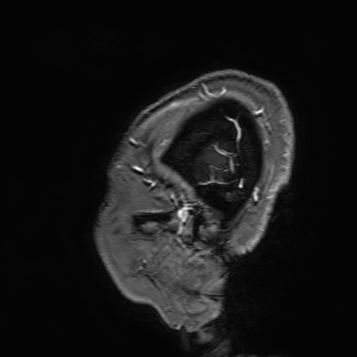 Cavernous hemangioma of the cerebellar falx (Radiopaedia 73025-83724 Sagittal T1 C+ 11).jpg
