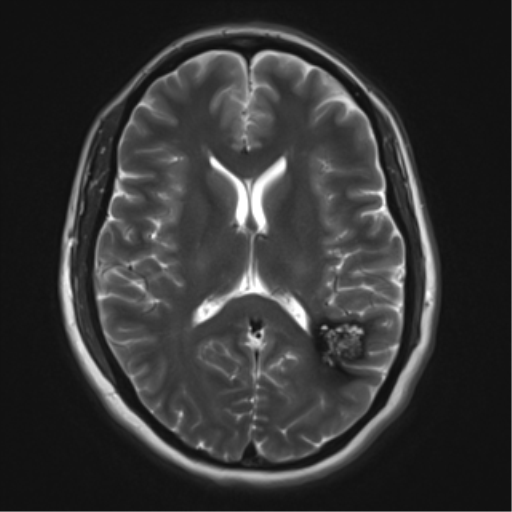 File:Cavernous malformation (cavernous angioma or cavernoma) (Radiopaedia 36675-38237 Axial T2 12).png