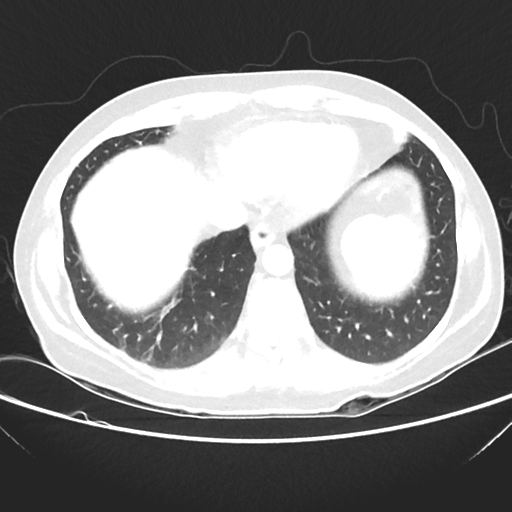 File:Cavitating lung mass - squamous cell carcinoma (Radiopaedia 48047-52854 Axial lung window 37).png