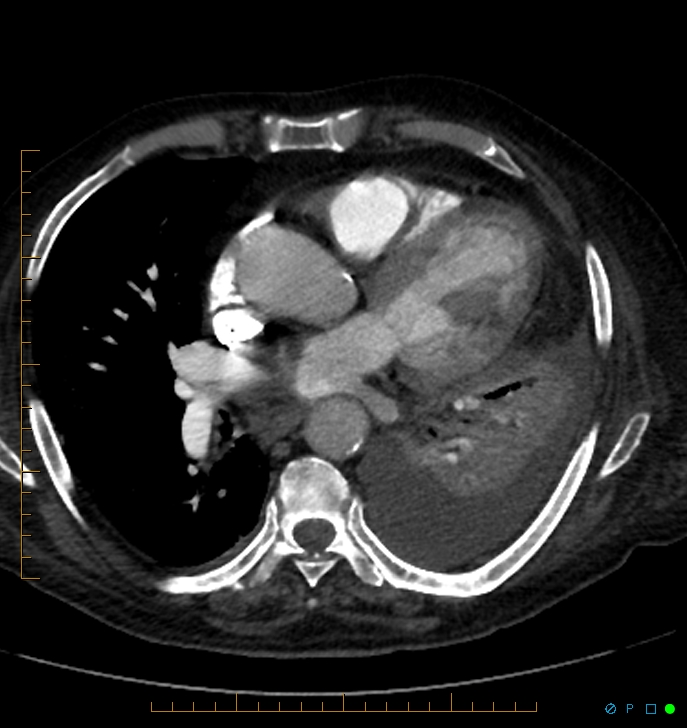 Cavitating pulmonary infarction (Radiopaedia 54634-60849 Axial C+ CTPA 47).jpg