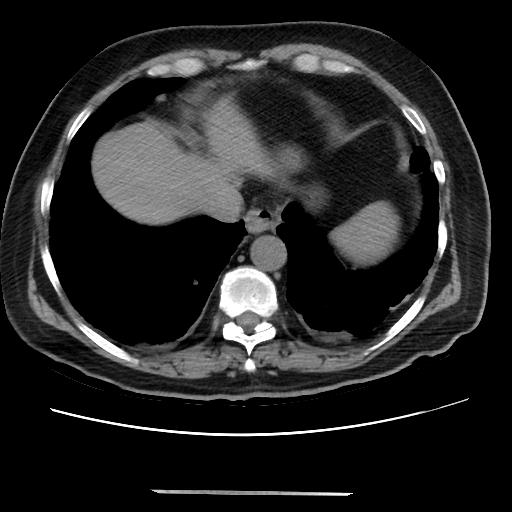 Cavitating pulmonary metastases (Radiopaedia 89545-106544 Axial non-contrast 44).jpg