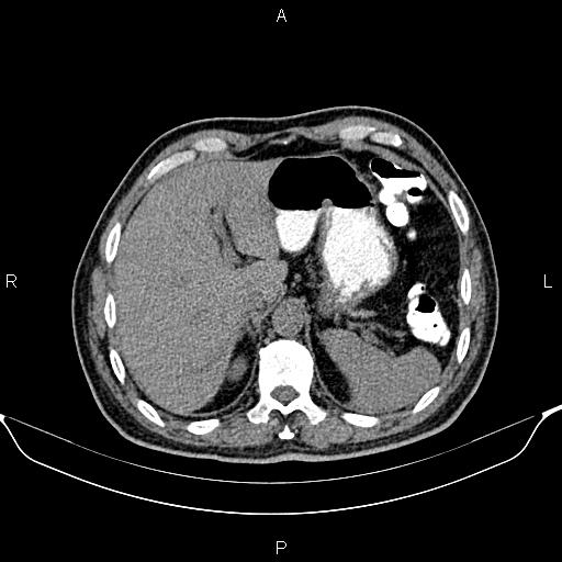 Cecal adenocarcinoma (Radiopaedia 85324-100916 Axial non-contrast 19).jpg