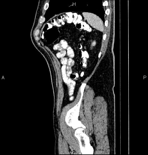 Cecal adenocarcinoma (Radiopaedia 85324-100916 E 80).jpg