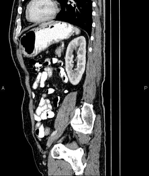 File:Cecal cancer with appendiceal mucocele (Radiopaedia 91080-108651 E 68).jpg