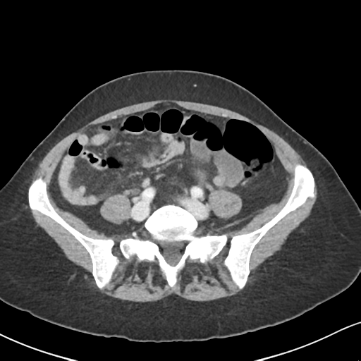 Cecal internal hernia through the foramen of Winslow (Radiopaedia 44820-48651 B 52).png