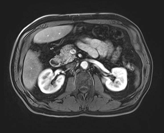 Cecal mass causing appendicitis (Radiopaedia 59207-66532 H 57).jpg