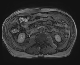 File:Cecal mass causing appendicitis (Radiopaedia 59207-66532 K 70).jpg