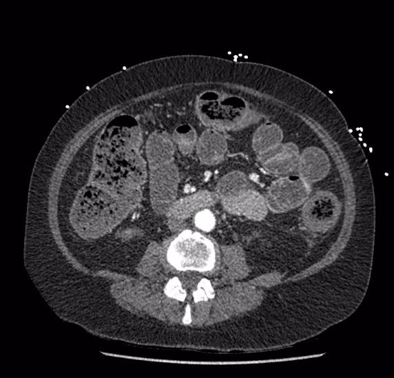 Celiac artery severe stenosis and dissection (Radiopaedia 44128-47842 B 51).jpg