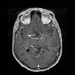 Central-variant posterior reversible encephalopathy syndrome (PRES) (Radiopaedia 43880-47358 Axial T1 C+ 69).jpg