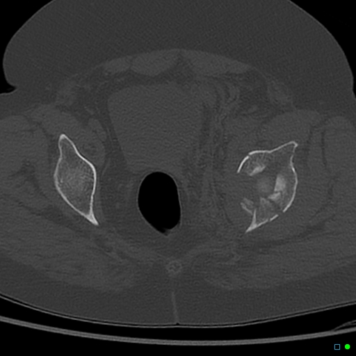 Central fracture-dislocation of the acetabulum (Radiopaedia 36578-38150 Axial bone window 52).jpg