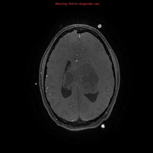 Central neurocytoma (Radiopaedia 13188-13206 Axial MRA 1).jpg