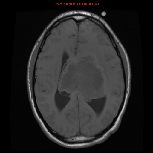 File:Central neurocytoma (Radiopaedia 13188-13206 Axial T1 5).jpg
