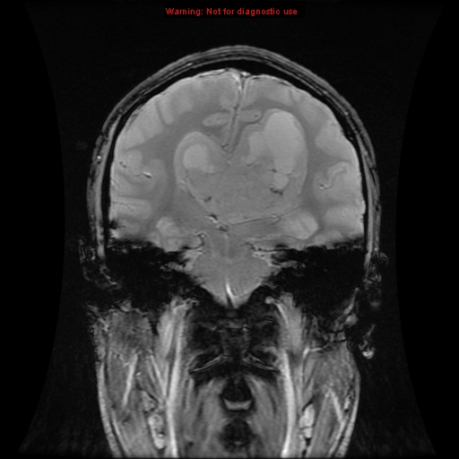 File:Central neurocytoma (Radiopaedia 13188-13206 G 6).jpg