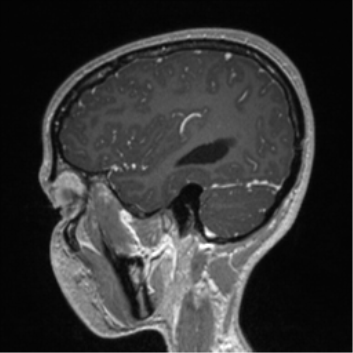 File:Central neurocytoma (Radiopaedia 37664-39557 Sagittal T1 C+ 25).png