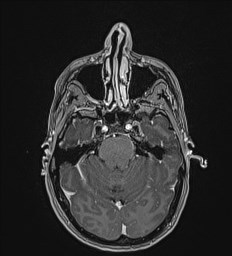 Central neurocytoma (Radiopaedia 84497-99872 Axial T1 C+ 46).jpg