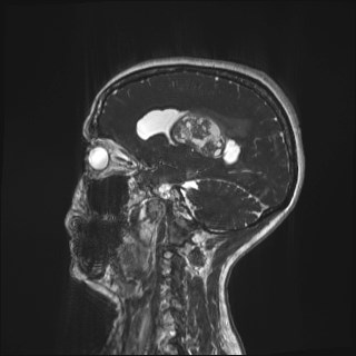 Central neurocytoma (Radiopaedia 84497-99872 Sagittal CISS 21).jpg