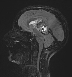 File:Central neurocytoma (Radiopaedia 84497-99872 Sagittal Flair + Gd 81).jpg