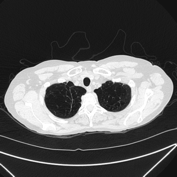 Centrilobular pulmonary emphysema (Radiopaedia 24495-24789 Axial lung window 9).jpg