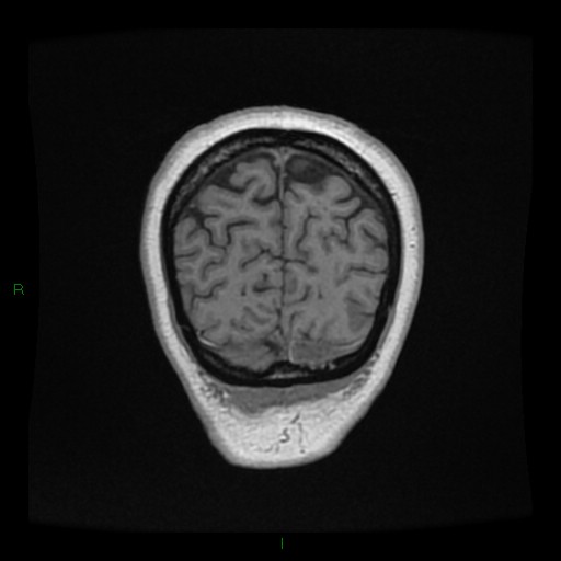 File:Cerebellar abscess (Radiopaedia 78135-90678 Coronal T1 C+ 149).jpg