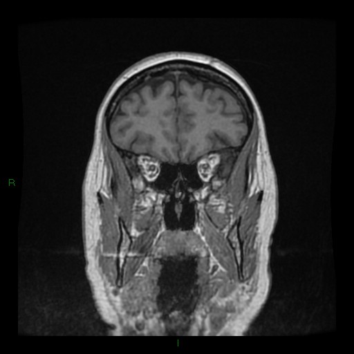 Cerebellar abscess (Radiopaedia 78135-90678 Coronal T1 C+ 40).jpg