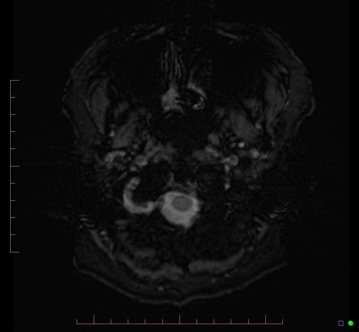 Cerebellar gangliocytoma (Radiopaedia 65377-74422 Axial SWI 1).jpg