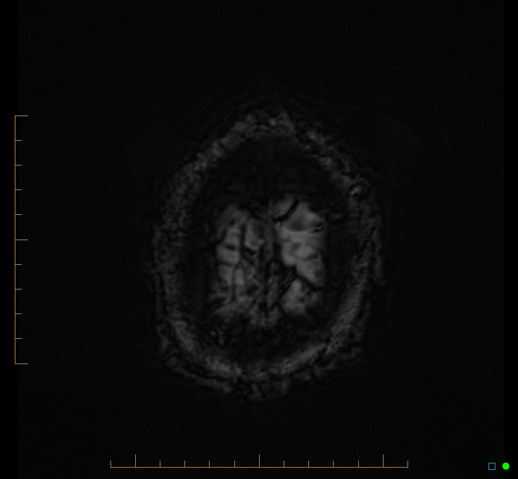 Cerebellar gangliocytoma (Radiopaedia 65377-74422 Axial SWI 58).jpg