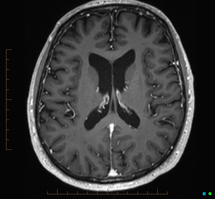 Cerebellar gangliocytoma (Radiopaedia 65377-74422 Axial T1 C+ 78).jpg