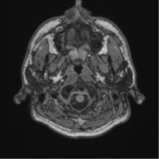File:Cerebellar hemangioblastomas and pituitary adenoma (Radiopaedia 85490-101176 Axial T1 4).png