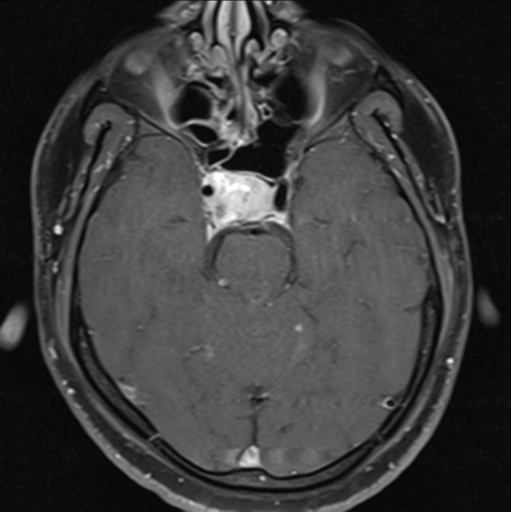 File:Cerebellar hemangioblastomas and pituitary adenoma (Radiopaedia 85490-101176 Axial T1 C+ fat sat 15).png