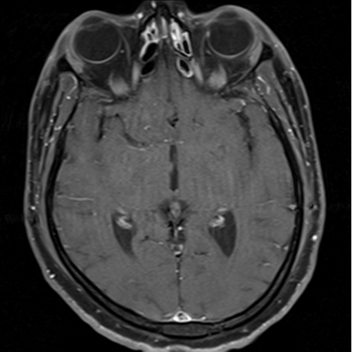 File:Cerebellar hemangioblastomas and pituitary adenoma (Radiopaedia 85490-101176 Axial T1 C+ fat sat 20).png