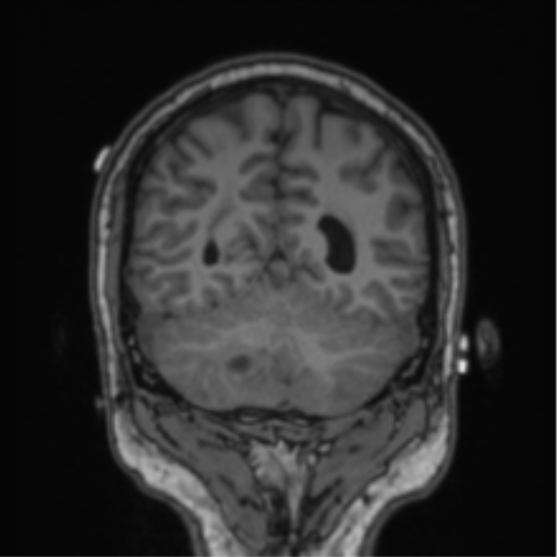 Cerebellar hemangioblastomas and pituitary adenoma (Radiopaedia 85490-101176 Coronal T1 30).png