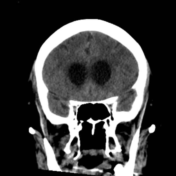 Cerebellar hemorrhage causing obstructive hydrocephalus (Radiopaedia 33989-35207 Coronal non-contrast 19).jpg