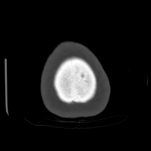 Cerebellar metastasis (cystic appearance) (Radiopaedia 41395-44258 Axial bone window 71).png