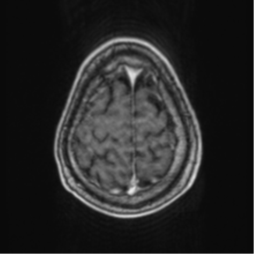 Cerebellar metastasis from lung adenocarcinoma (Radiopaedia 86690-102829 Axial T1 C+ 69).png